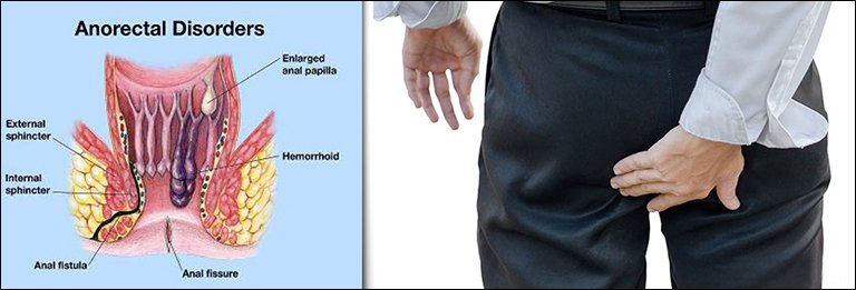 Anorectal Disorders